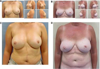 Autologous vs. implant-based breast reconstruction after skin- and nipple-sparing mastectomy—A deeper insight considering surgical and patient-reported outcomes